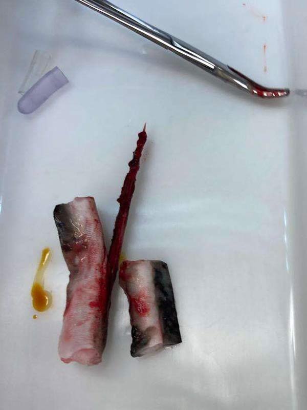 the stingray barb after it was removed