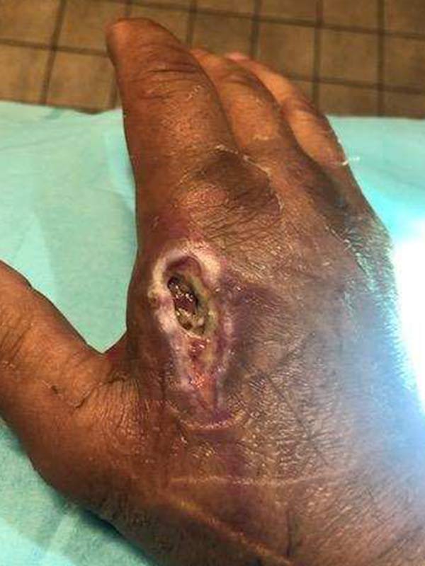 Bryon's hand early in the injury