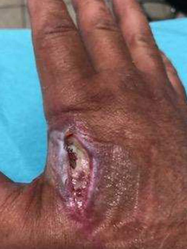 Bryon's hand injury progression