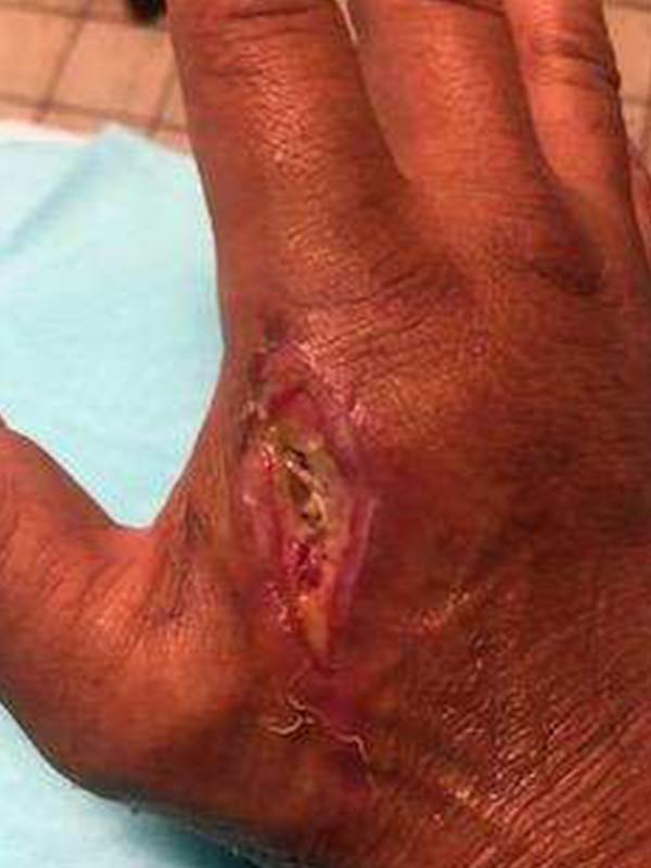 Bryon's hand injury progression