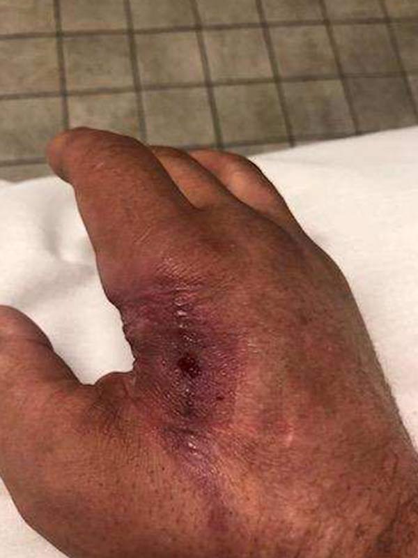 Bryon's hand injury progression