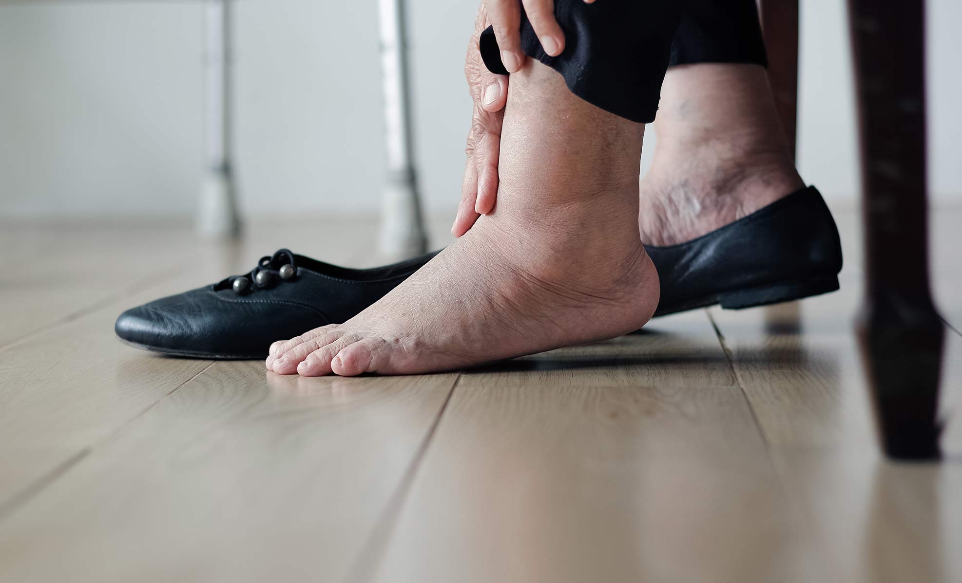 patient grabs swollen foot in pain
