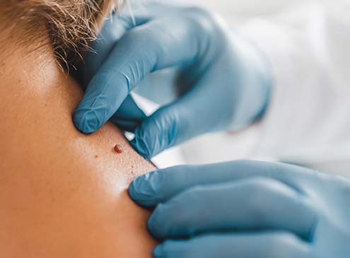 dermatologist inspecting a mole on a woman's shoulder
